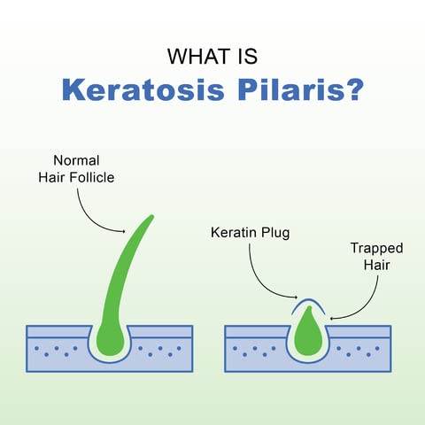 K Element Keratosi Pilari Lotio ( f oz Natura Keratosi Pilari Treatment Moisturizin Exfoliatin AH Lotio fo KP Vegan Mad i USA
