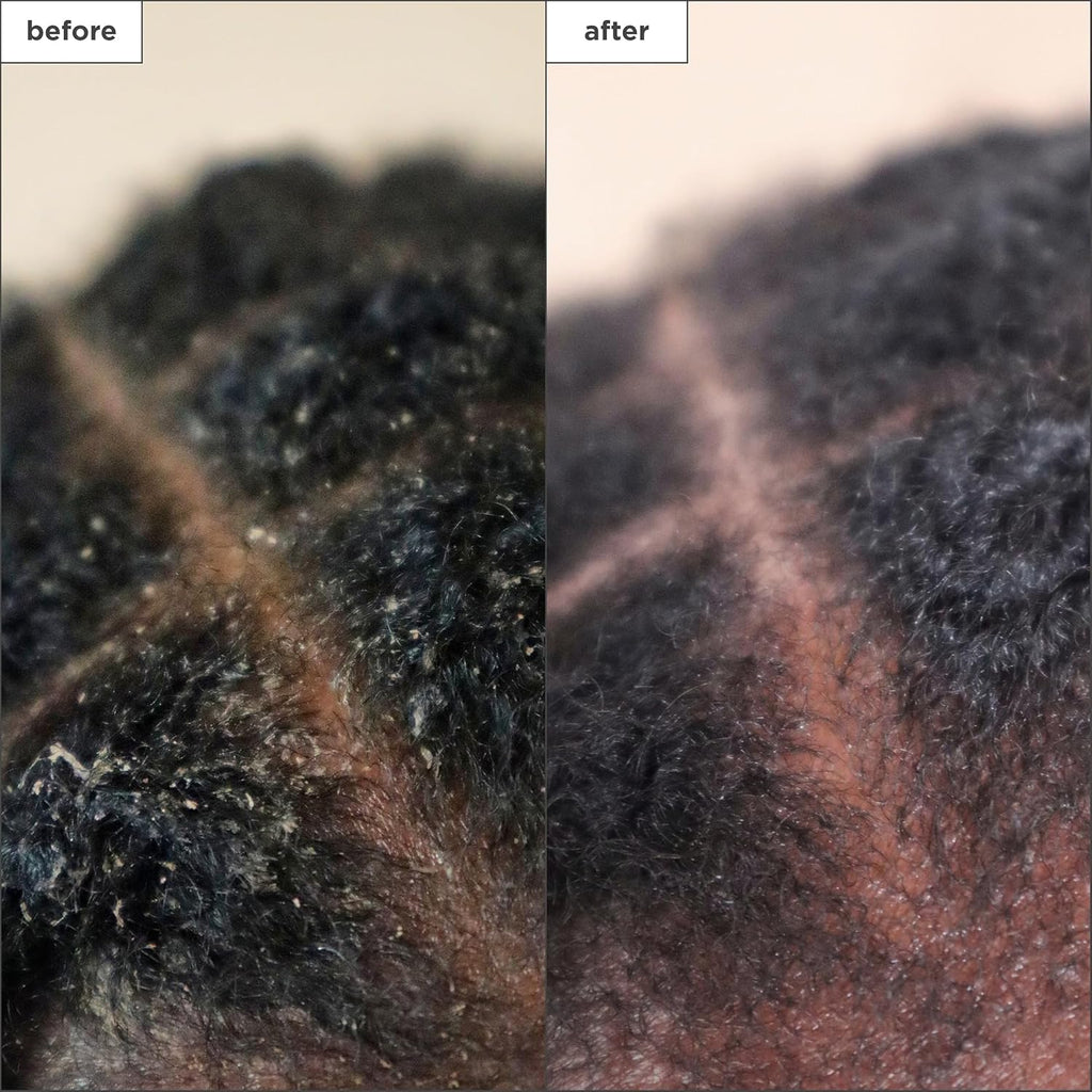Brioge Scal Reviva Charcoa Te Tre Scal Treatment Scal Seru t Sooth Dry Flaky Itch Scalp Absor Oil Hydrat Dr Scalp Clarif Buil Up Vegan Cruelty-Free f oz