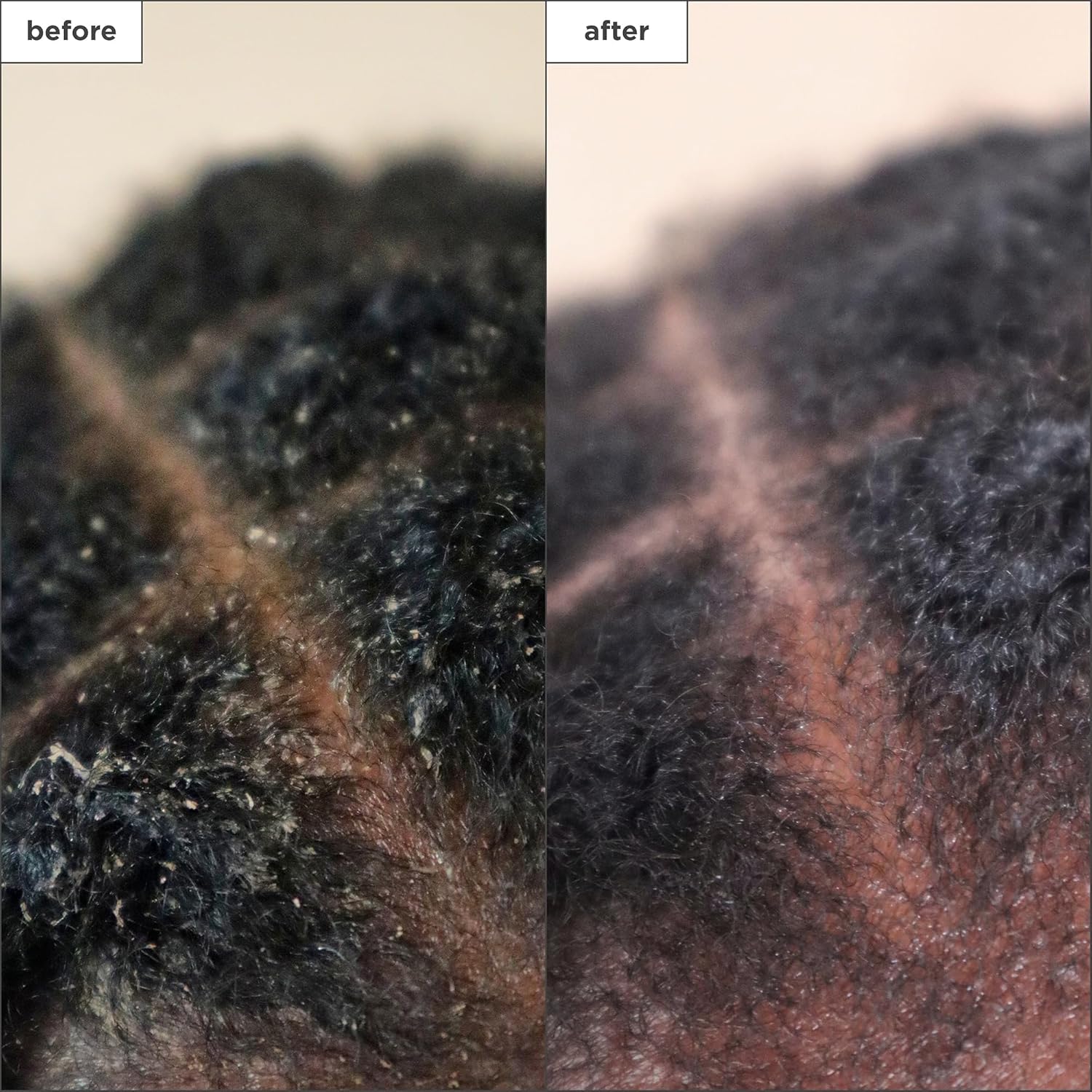 Brioge Scal Reviva Charcoa Te Tre Scal Treatment Scal Seru t Sooth Dry Flaky Itch Scalp Absor Oil Hydrat Dr Scalp Clarif Buil Up Vegan Cruelty-Free f oz