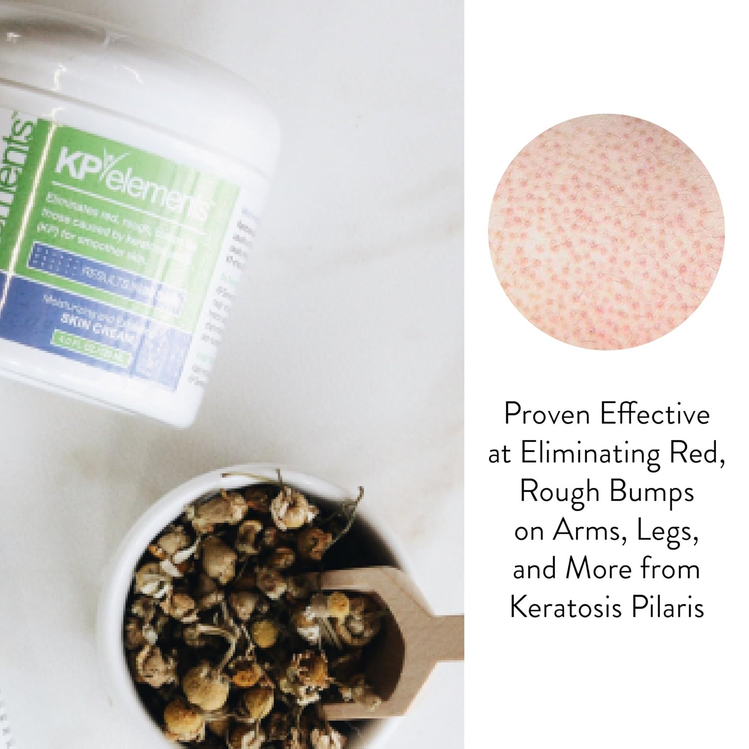 K Element Keratosi Pilari Lotio ( f oz Natura Keratosi Pilari Treatment Moisturizin Exfoliatin AH Lotio fo KP Vegan Mad i USA